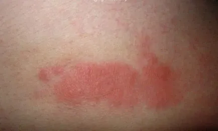 Allergiás a csípésével poloska okok, tünetek, kezelés (poloskák) Allergiás a csípésével poloska okok, tünetek, kezelés
