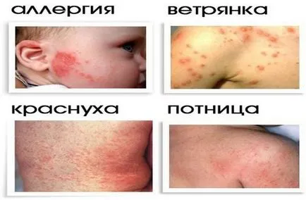 Allergia csecsemők hogyan teremthettek, hogyan lehet azonosítani és kezelni