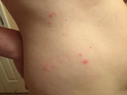 Allergiás a csípése poloska gyermekek és felnőttek hogyan kell nézni, és hogyan kell kezelni