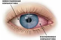 Нематода в окото причините и лечението