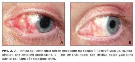киста на очите