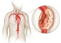 hasi aorta aneurizma kerülnek bevezetésre, hogy a korai tünetek és a kezelés (jelei hasi aorta aneurizma) hasi aorta aneurizma kerülnek bevezetésre, hogy a korai tünetek és a kezelés