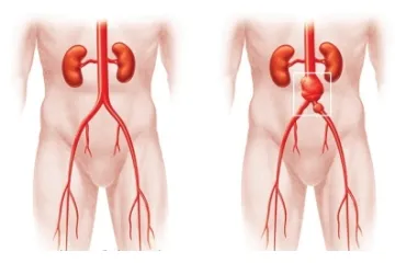 hasi aorta aneurizma kerülnek bevezetésre, hogy a korai tünetek és a kezelés (aneurizma) hasi aorta aneurizma kerülnek bevezetésre, hogy a korai tünetek és a kezelés