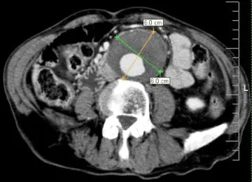hasi aorta aneurizma kerülnek bevezetésre, hogy a korai tünetek és a kezelés (aorta) hasi aorta aneurizma kerülnek bevezetésre, hogy a korai tünetek és a kezelés