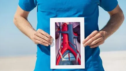 A hasi aorta aneurizma tünetei, diagnózisa, kezelése (hasi) A hasi aorta aneurizma tünetei, diagnózisa, kezelése
