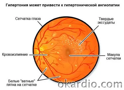 Retina angiopathy mi ez, okai, tünetei és kezelése