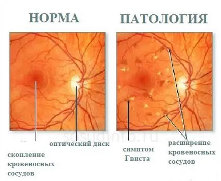retinális vaszkuláris angiopátia okoz a szem kezelésére (retina) retinális vaszkuláris angiopátia okoz szem kezelésére