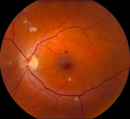 Retina angiopathy mi ez, okai, tünetei és kezelése