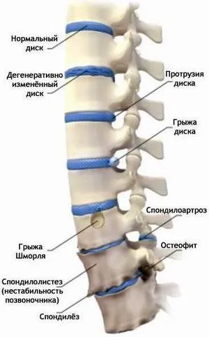 хемороиди лечение без операция в глобален клиника