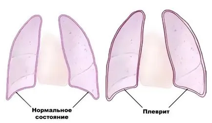 плеврит лечение на белодробни и народната медицина у нас