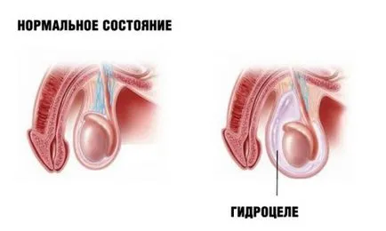 хидроцеле тестис лечение народни средства