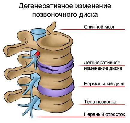 хемороиди лечение без операция в глобален клиника