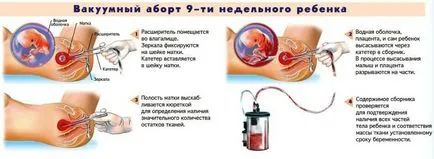 Месец след аборт (спонтанен аборт) - при стартиране, идва, защо не, чрез