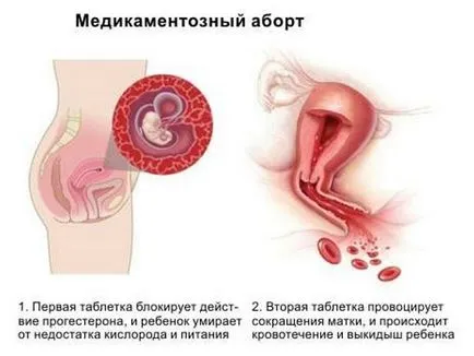 Месец след аборт (спонтанен аборт) - при стартиране, идва, защо не, чрез