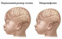 Микроцефалия - причини, симптоми, диагностика и лечение