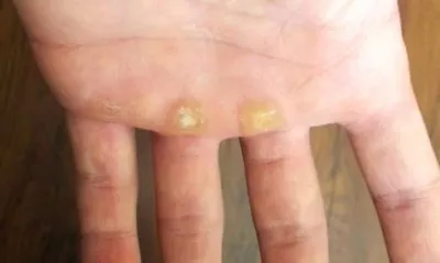 Calluses на ръцете причини за симптомите, знаци, лечение и диагностика (като народни средства за мазоли по ръцете) Calluses на ръцете причини за симптомите, признаци лечението и диагностиката
