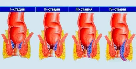 Фолк и консервативно лечение на вътрешни хемороиди