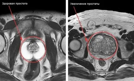 Mri тазовата показва, че подготовката, четене