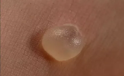 Calluses на ръцете причини за симптомите, знаци, лечение и диагностика (царевица процес на ръка) Calluses на ръцете причини за симптомите, признаци лечението и диагностиката