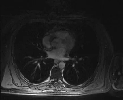коремна MRI какво е, кои органи да проверят