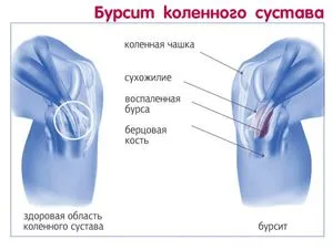Остра болка в коляното - защо това се случи, и внезапното пулсираща болка в коляното