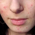Face пилинг - това е химическа, ултразвук и др преди и след снимки, как да се направи в