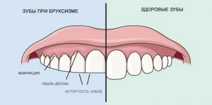 Защо един човек, шлайфане зъбите си в съня си - основните причини