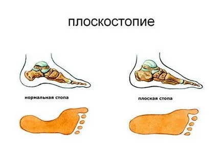 Плосък при юноши снимка, причини, симптоми, лечение, профилактика, както и да се определи как да се отнасяме