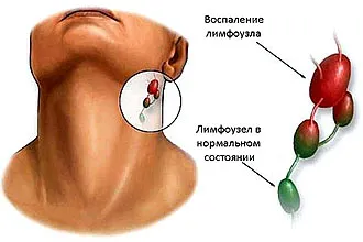 Защо възпалени лимфни възли зад ушите - основни причини