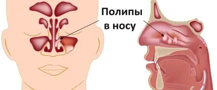 Назални полипи симптоми, причини и лечение