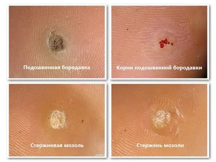 Брадавици или суха царевица - как да се разграничат