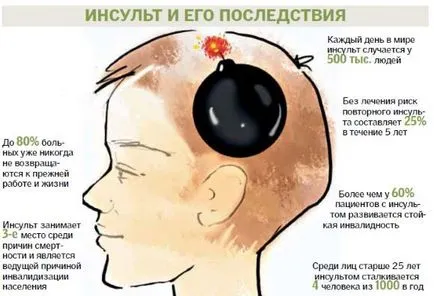 инсулт последици в дясното полукълбо на мозъка