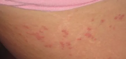 Пъпки по дланите, пръстите на ръцете