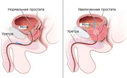Симптомите на рак