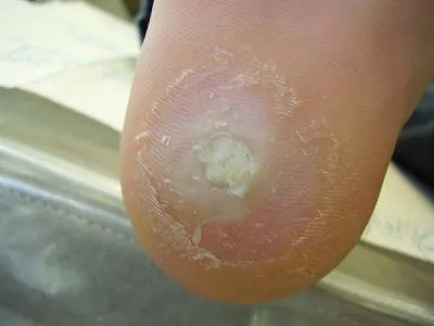 calcaneal шпора