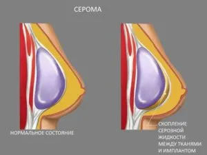 Физиологични течности след операцията, и отстраняване на причините за
