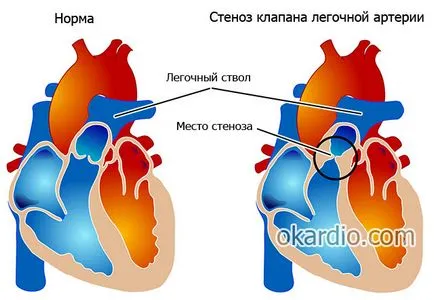 Сърце шум при възрастни причинява, видове, симптоми и лечение (причини) Шум на сърцето при възрастни води, видове, симптоми и лечение