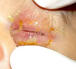 Ophthalmia az újszülöttekben a tünetek, a kezelés, megelőzés (profilaxis) Ophthalmia az újszülöttekben a tünetek, a kezelés, megelőzés