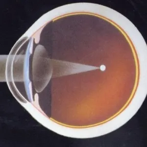 Myopia leírás, kezelés, okai, tünetek