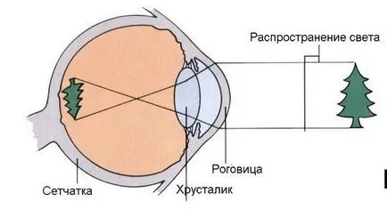 Myopia leírás, kezelés, okai, tünetek