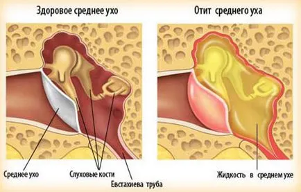 Betegségek, a fül az ember mik a tünetek és a kezelés, fotó, megelőzés (kezelése fül betegség emberben) Betegségek emberi fül mik a tünetek és a kezelés, fotó, megelőzés