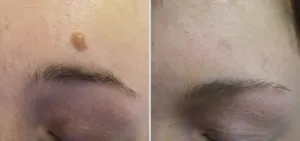 Невус отстраняване как да го премахнете като у дома си, какво да правя след отстраняване на