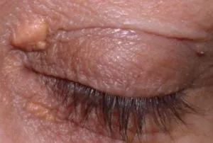 Печат или бум на горния клепач го Chalazion, ечемик, блефарит