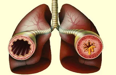 Hörgőgörcs gyermekek cimptomy és kezelésében, mint, hogy vonja vissza, a kábítószer és a sürgősségi ellátás (kezelés) Cimptomy hörgőgörcs gyermekek és kezelésében, mint hogy vonja vissza, gyógyszerek és elsősegély
