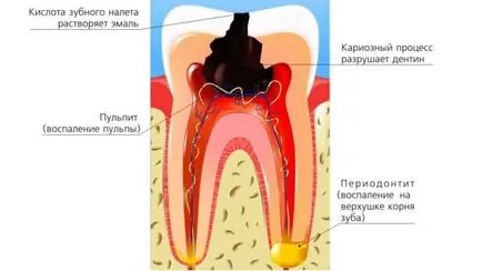 Fogfájás tisztítás után a kezelés csatornák, tömítő és fotó (csatornák) Fogfájás csatornák tisztítás után a kezelés, tömítő és fényképek
