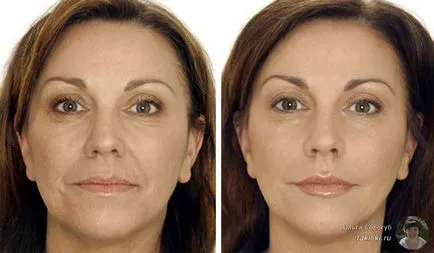Botox arc válaszokat és az esetleges negatív következményeket (negatív) Botox arc válaszokat és az esetleges negatív következmények
