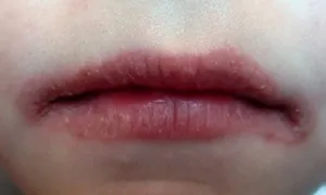 заболявания на устната кухина, на лигавицата и езика при възрастни лечение снимка