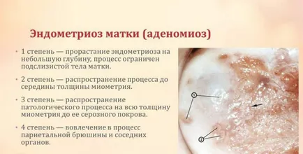 матката аденомиоза, че е достъпен език със снимка
