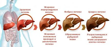 Алкохолни симптоми и лечение чернодробно заболяване
