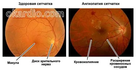 Ретината ангиопатия какво е, причини, симптоми и лечение